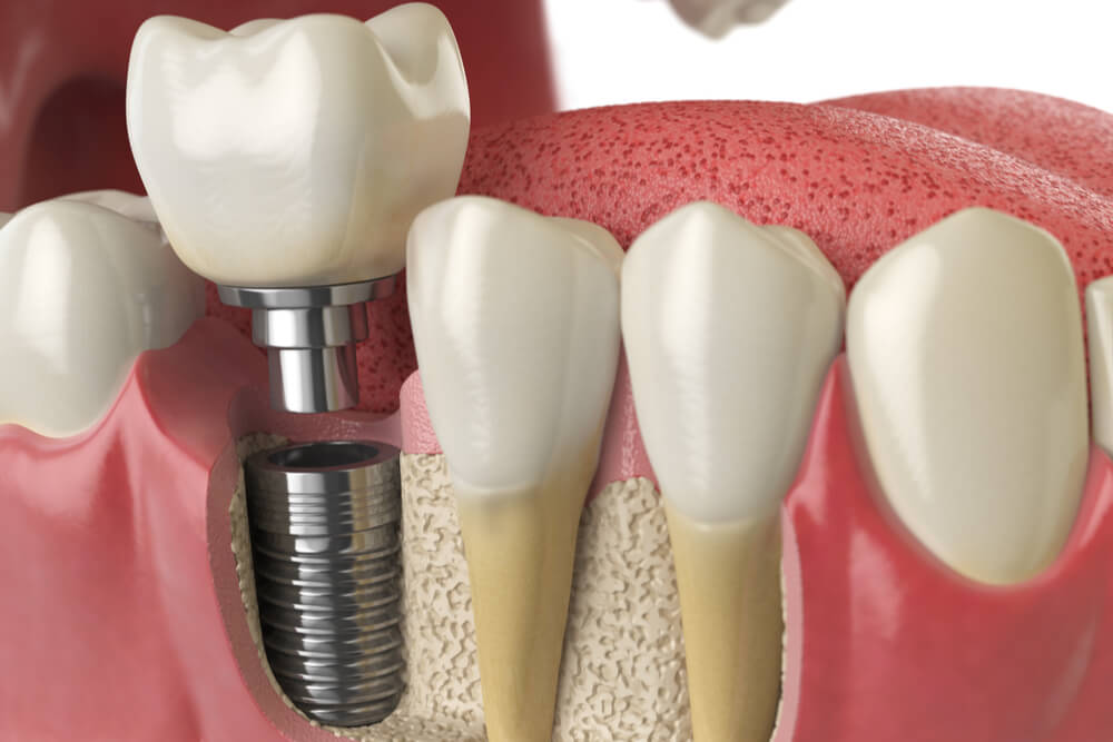 implantologia dentale dentistalbania